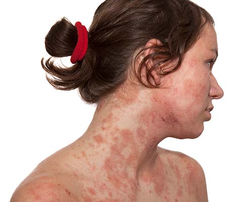 Atopic Dermatitis | Pfizer Canada Atopic Dermatitis | Pfizer Canada